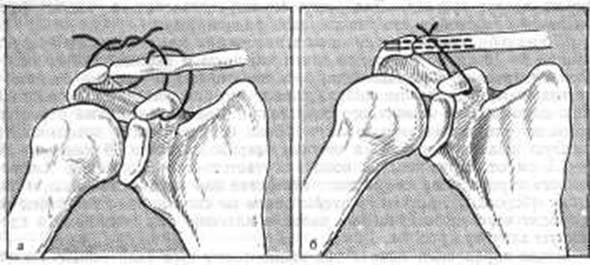 Акс ключицы. Вывих акромиально-ключичного сустава операция. Вывих ключицы разрыв акс. Вывих акс плечевого сустава. Вывих акромиально-ключичного сустава пластина.