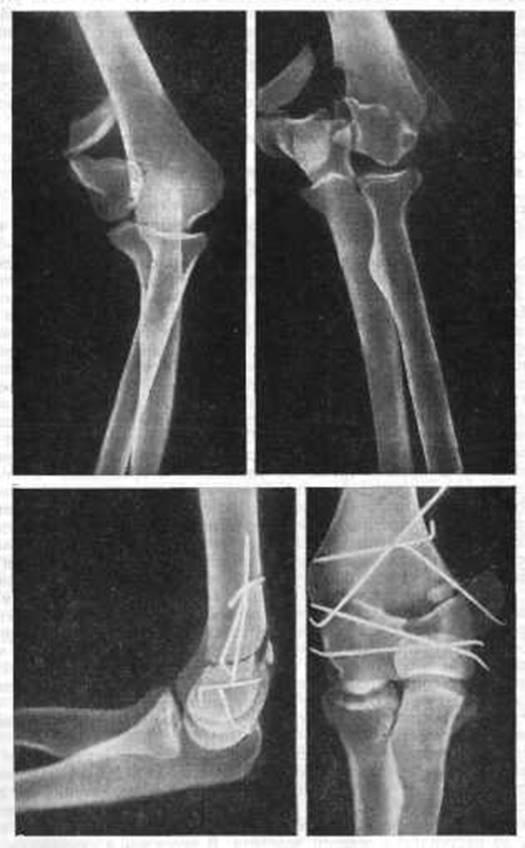 Перелом локтя со смещением. Мыщелковый перелом локтевой кости. Чрезмыщелковый перелом плечевой кости остеосинтез. Перелом мыщелка плечевой кости. Остеосинтез наружного мыщелка плечевой кости.