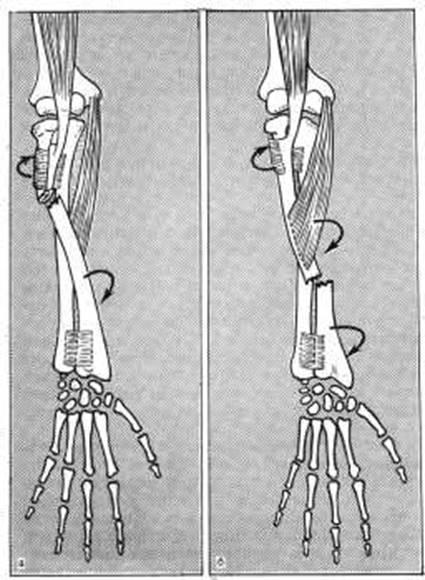 Перелом предплечья обе кости