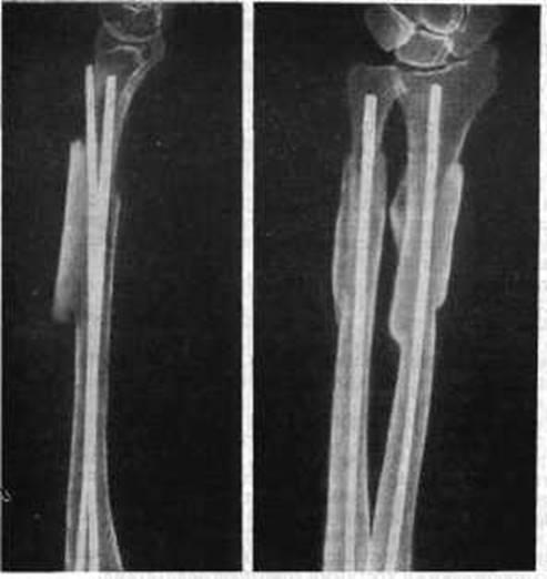 Обеих костей. Интрамедуллярный остеосинтез лучевой кости. Перелом костей предплечья остеосинтез. Перелом обеих костей предплечья остеосинтез. Остеосинтез переломов диафизов костей предплечья.