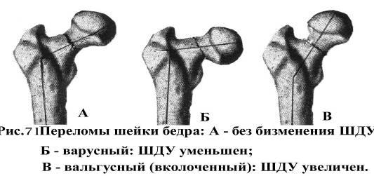 Перелом шейки бедра карта вызова