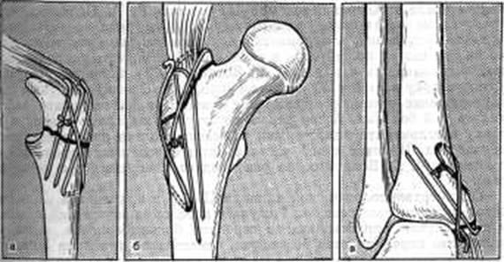 Операция перелом локтевого отростка. Остеосинтез локтевого отростка по Веберу. Остеосинтез перелома локтевого отростка по Веберу. Серкляжный остеосинтез это. Перелом локтевого отростка остеосинтез.